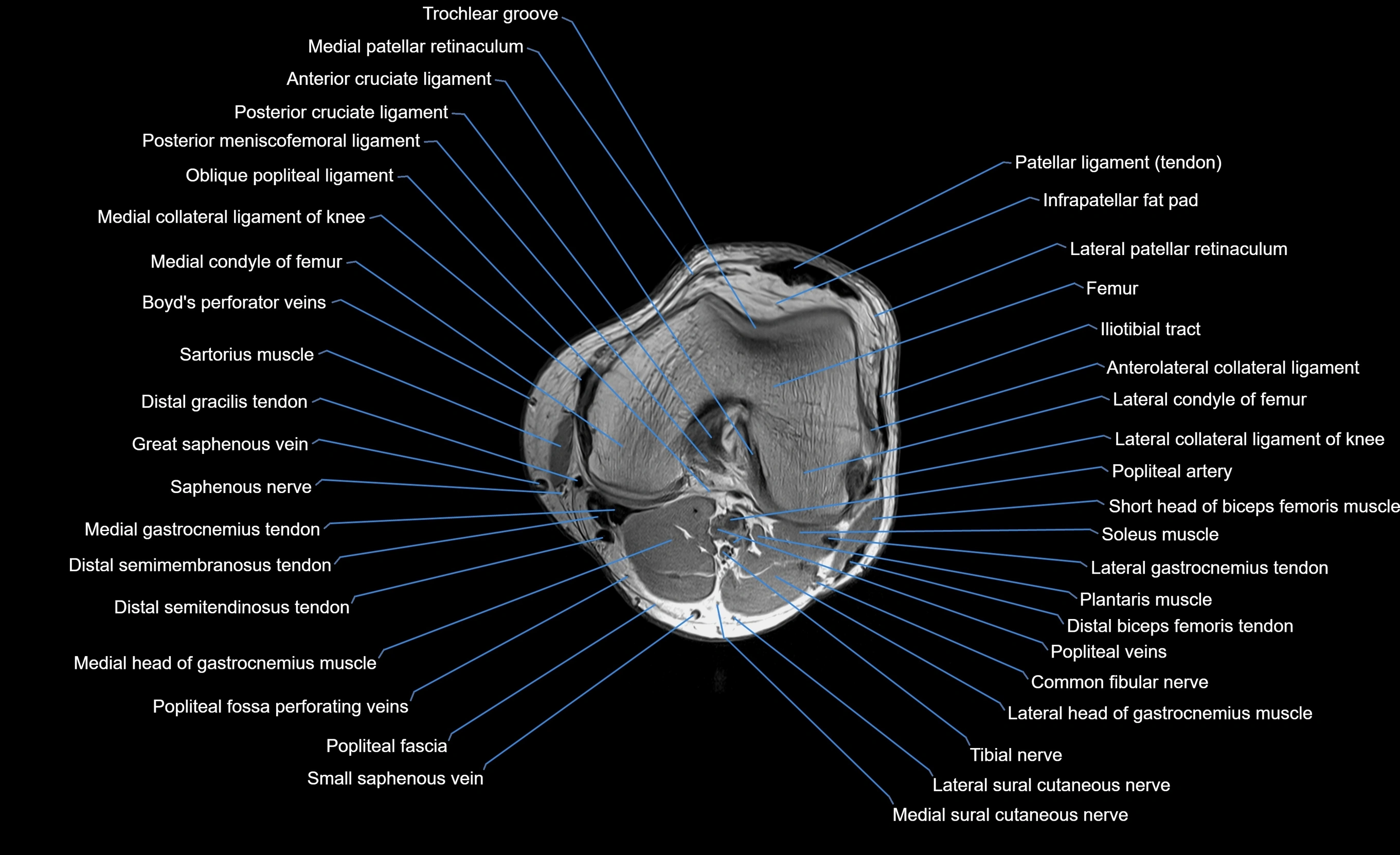 MRI lower leg axial cross sectional anatomy 3T  radiology  image-img-00001-00013.webp